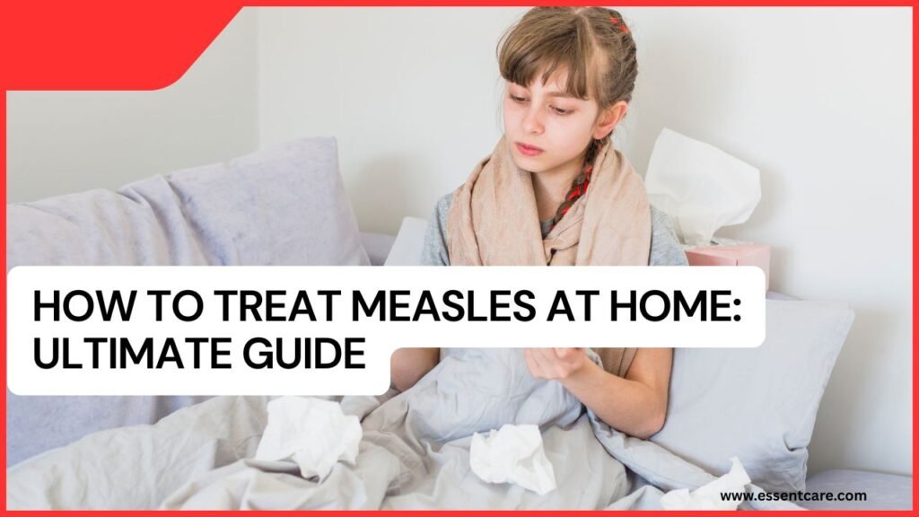 How to Treat Measles at Home: Ultimate Guide